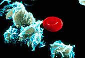 Coloured SEM of hairy cell leukaemia cells