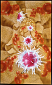 Artwork of leucocytes in hairy cell leukaemia
