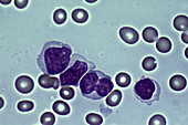 Leukemia