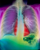 False-colour X-ray showing lung cancer