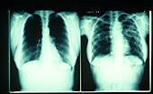 A/P view X-rays of lungs