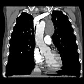 CT reconstruction of chest