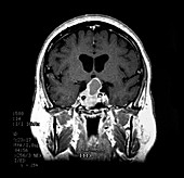 MRI of Pituitary tumour-