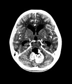CT of Medulloblastoma