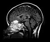 MRI of Esthesioneuroblastoma