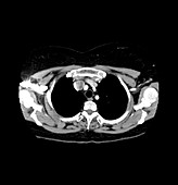 Necrotic Mediastinal Lymph Node on CT