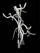 3D angiogram of carotid artery stenosis