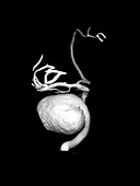 3D cerebral angiogram of giant aneurysm