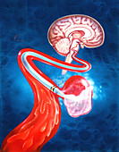 Illustration of brain aneurysm therapy