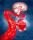 Illustration of a brain aneurysm
