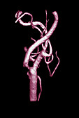 3D Angiogram of Carotid Stenosis