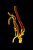3D Angiogram of Ulcerated Stenosis