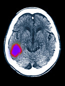Cerebral CT scan showing stroke