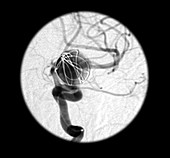 Intracranial Aneurysm