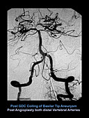 Cerebral angiogram