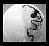 Angiogram of Arterial Venous Malformation