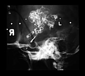 Lateral Skull X-Ray
