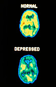 Depression: 2 axial PET scans of the brain