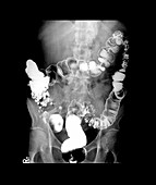 Diverticulosis in the Large Intestine