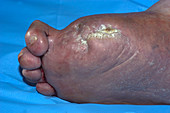 Diabetic foot with toe amputations