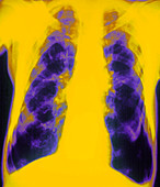 Col X-ray: chronic pulmonary disease (emphysema)