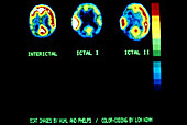 PET Scan Showing Epileptic Seizure