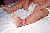Eczema Vaccinatum