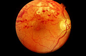 Branch retinal vein occlusion