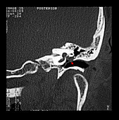 CT image of Cholesteatoma