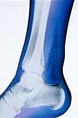 Coloured X-ray of foot with necrotising fasciitis