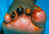 Gangrene of toes due to diabetes mellitus