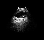 Ultrasound of Gallstones