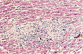 Granulomatous Myocarditis