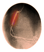 Angiogram showing stent