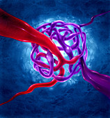 Illustration of arteriovenous malformation