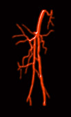 Angiogram of Femoral Artery