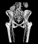 Pelvis and Upper legs with Arteriosclerosis