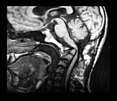 MRI of Basilar Invagination