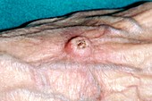 Keratoacanthoma on the back of the hand