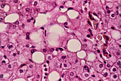 Light micrograph of a section through fatty liver
