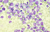 Leukemia