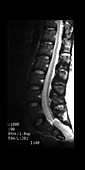 MRI of Tethered Cord and Lipoma