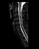 Cervical Spinal Cord with Multiple Sclerosis