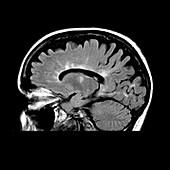 MRI of Multiple Sclerosis