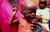 Malnourished child