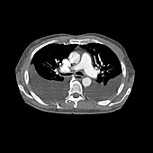 CT of the chest