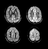 MRI of Pachygyria