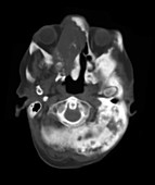 CT of Severe Paget's Disease