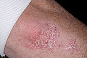 Plaque psoriasis on elbow