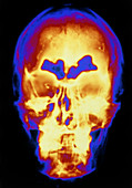 F/col X-ray showing skull with frontal sinusitis